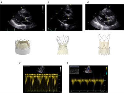 Patient Prosthesis Mismatch After SAVR and TAVR